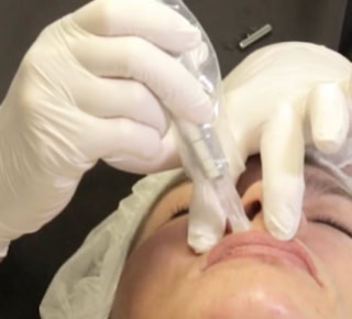 Micodermabrasion